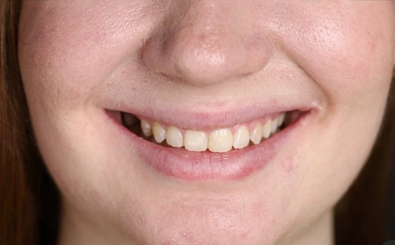 След лечение