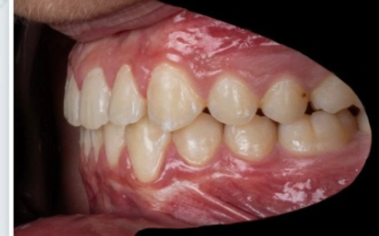 След лечение